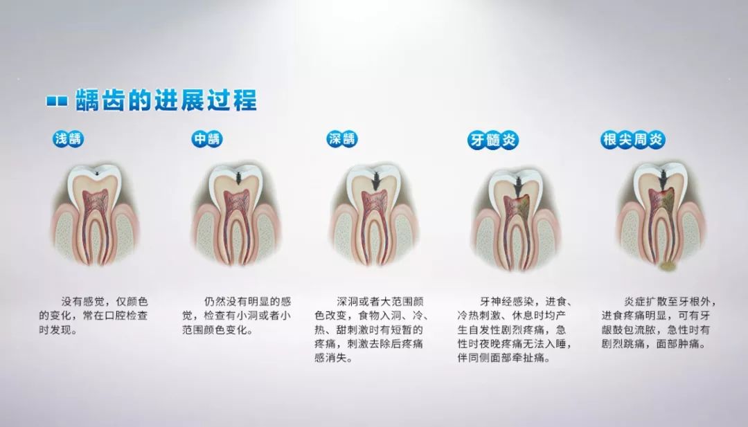 进一步发展:如果深龋未经治疗,则牙髓继发感染或牙髓坏死.
